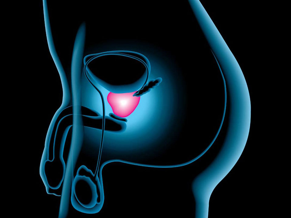 Terapia de radiación y hormonas salva vidas en cáncer de próstata