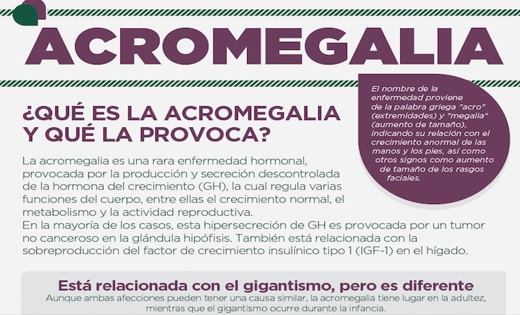 10 datos que quieres saber sobre la Acromegalia