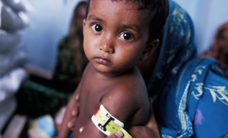 Derechos humanos y desnutrición infantil