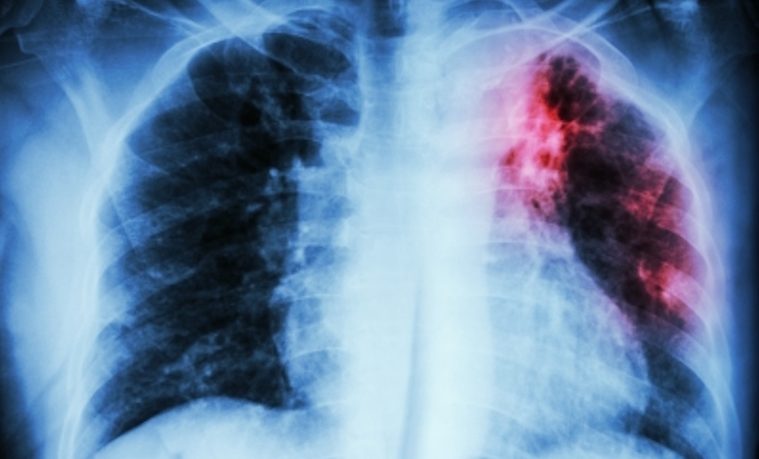 La OMS recomienda nuevo test de diagnóstico rápido para la tuberculosis